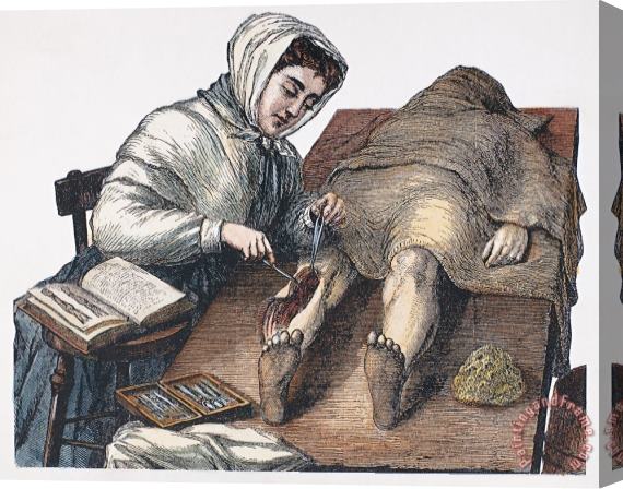 Others DISSECTION, 19th CENTURY Stretched Canvas Print / Canvas Art